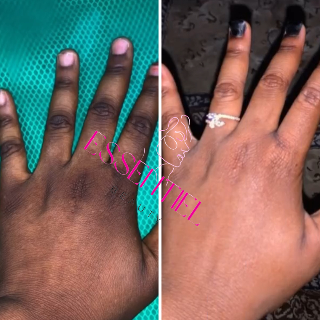 COMMENT TRAITER LES ZONES SOMBRES DU CORPS ?