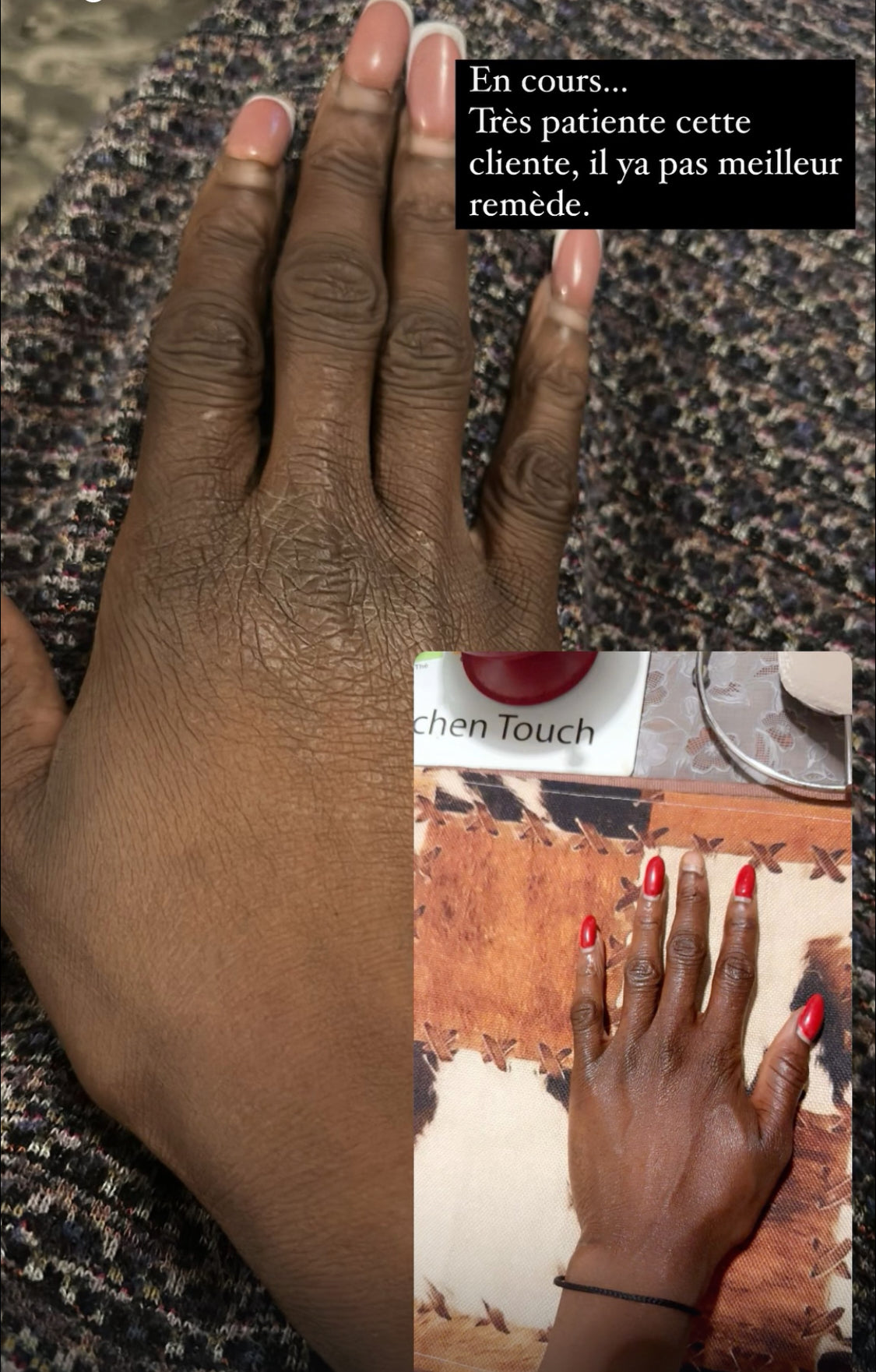 Adieu les Quintos Sévères : La Routine Complète pour une Peau Uniforme et Lisse