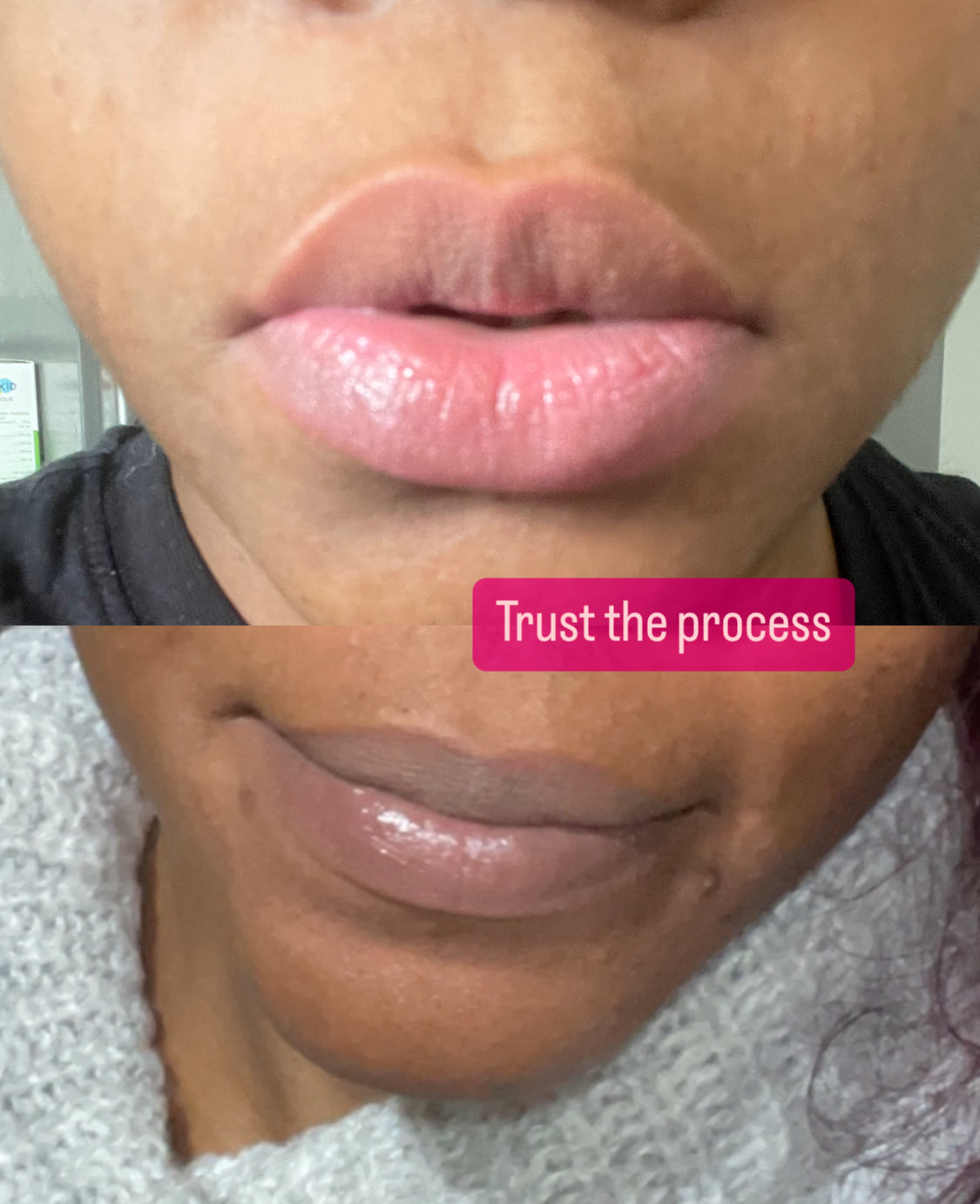 Lèvre rose avant après 