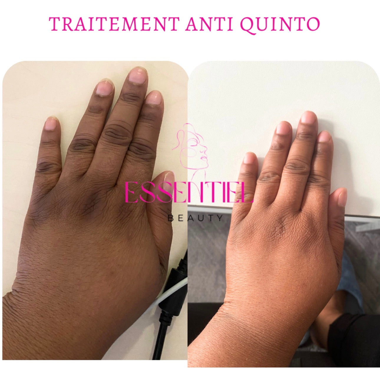 SÉRUM CORRECTEUR CIBLÉ ANTI-QUINTOS
