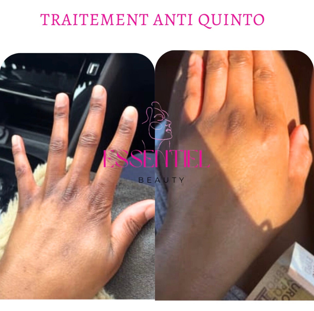 SÉRUM CORRECTEUR CIBLÉ ANTI-QUINTOS