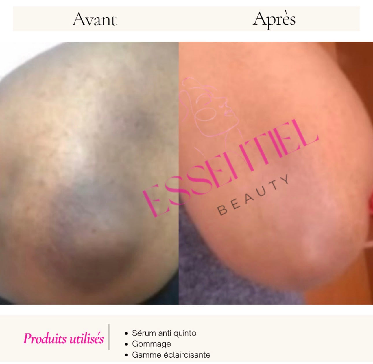 SÉRUM CORRECTEUR CIBLÉ ANTI-QUINTOS